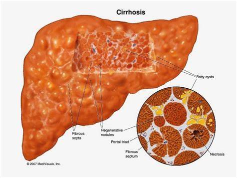 livercirrhosis